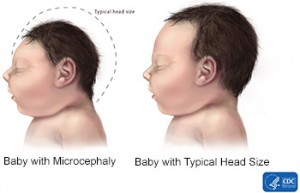 Microcephaly is a birth defect where a baby's head is smaller than expected when compared to babies of the same sex and age.