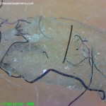 Morgellons disease: the search for a perpetrator